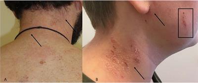 Malassezia-Associated Skin Diseases, the Use of Diagnostics and Treatment